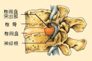 椎间盘突出示意图