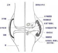 关节炎症状表现